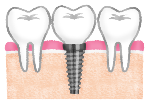 Dental implant between teeth clipart
