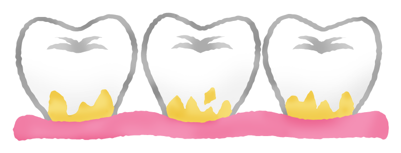 Dental plaque