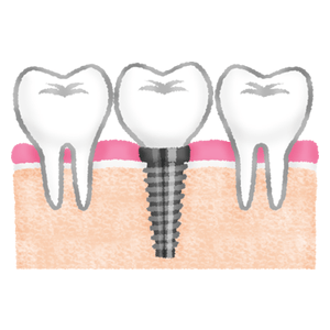 Implante dental entre dientes
